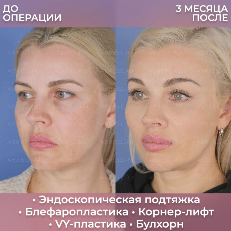 Результат пластики лица у Бурловой Марии Григорьевны