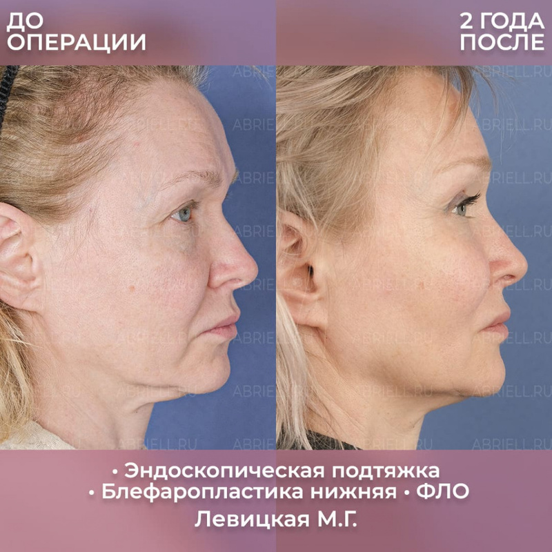 Результат пластики лица у Бурловой Марии Григорьевны