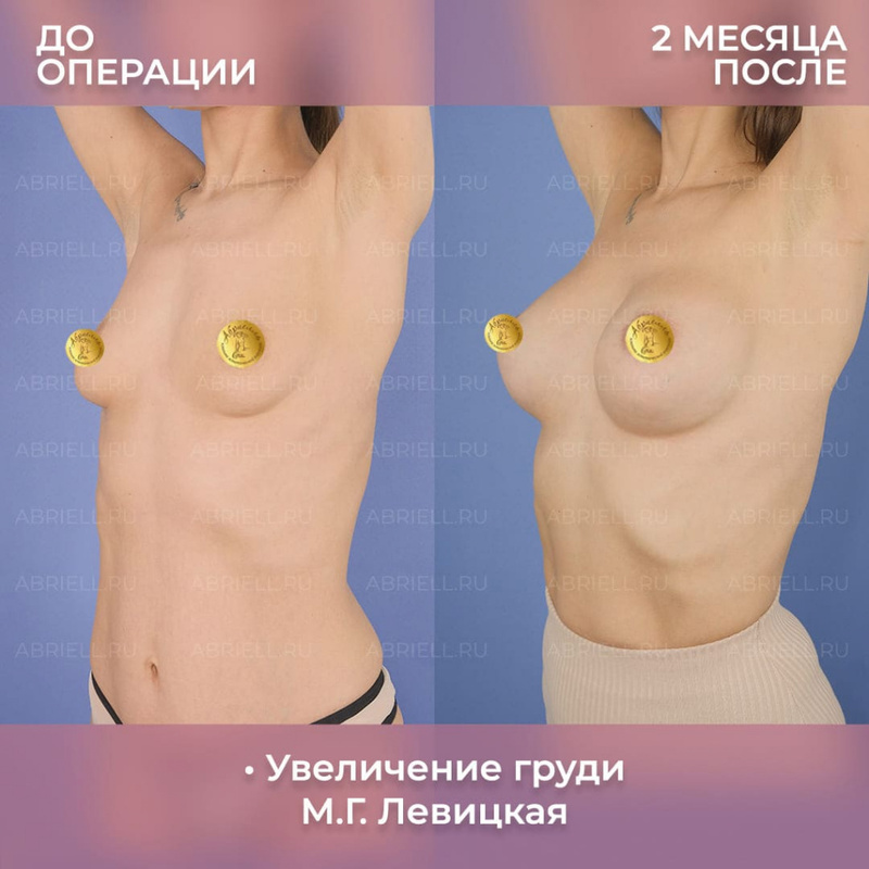 Результат маммопластики у Бурловой Марии Григорьевны
