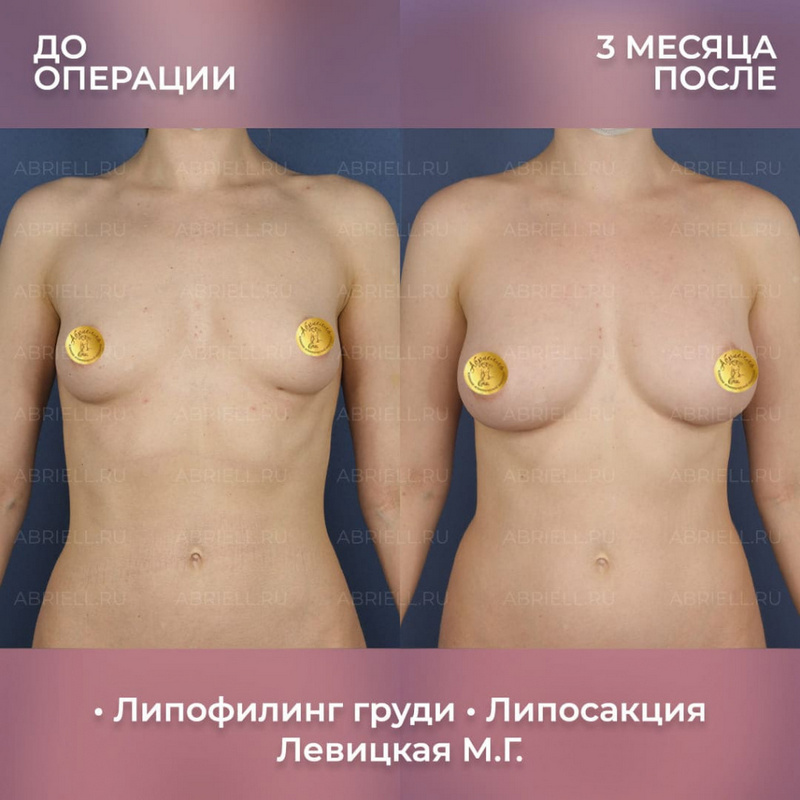 Результат маммопластики у Бурловой Марии Григорьевны
