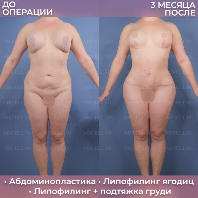 Результат пластики тела у Бурловой Марии Григорьевны