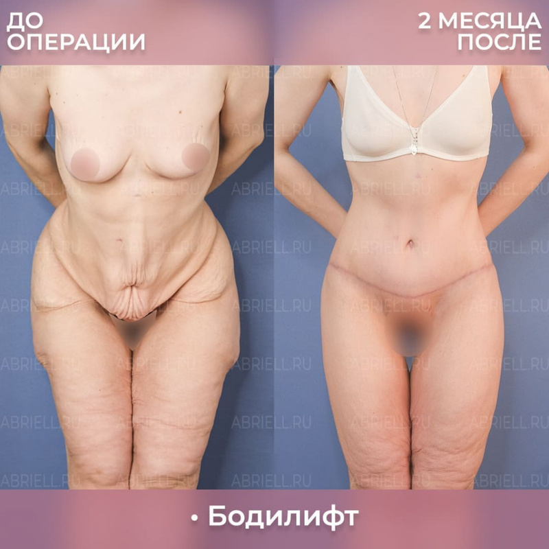 Результат пластики тела у Бурловой Марии Григорьевны